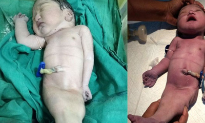 Hindistan’da “Denizkızı sendromu”yla bebek doğdu!