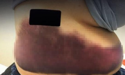 Öksürmekten kaburgaları kırıldı!