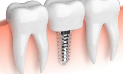 Diş Eti Hastalıkları ve İmplant Süreci