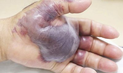 Bakteri bulaştı, tek çare elini kesmek