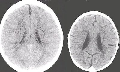 Bilim insanları açıkladı: İlgi görmeyen çocuğun beyni böyle görünüyor