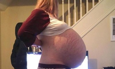 Galli kadından 26 kiloluk yumurtalık kisti alındı