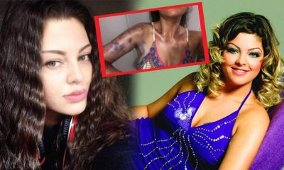 Sinem Umaş’ın kolları yandı