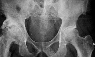 Doktorları şaşkına çeviren röntgen: Diz ağrısıyla gitti sonuç şok etti