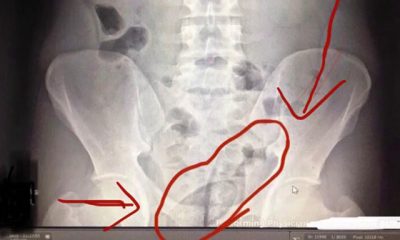 2 İranlı’nın bağırsaklarından 150 gram metamfetamin ve 30 gram esrar çıktı