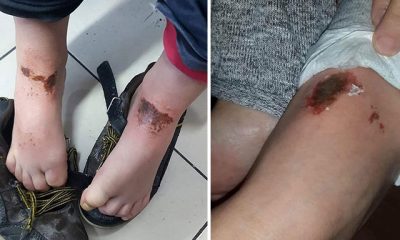 Okul bahçesinde kar topu oynayan öğrencilerin vücutlarında yanıklar oluştu