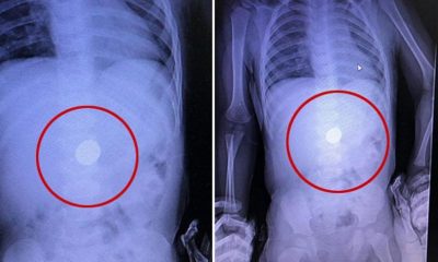 Röntgende tespit edildi, doğal yollarla çıkarması beklenecek!