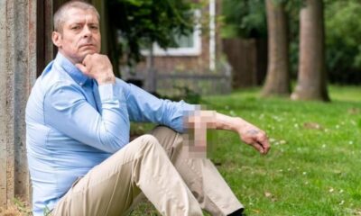 Talihsizliğin böylesi: Kolunda penisiyle 4 yıldır yaşıyor!