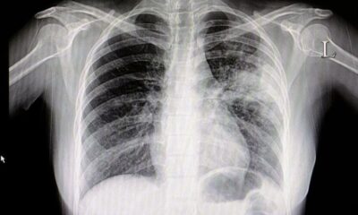 İki doz aşı olup coronaya yakalananlar anlattı