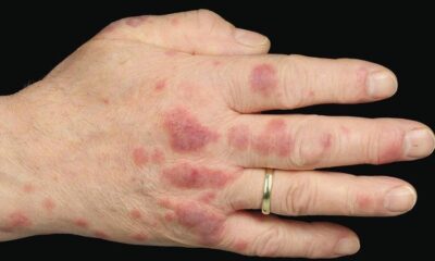 Ellerinde çıkan lekeler için hastaneye başvuran kişi şok oldu