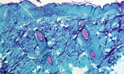 DSÖ: Maymun çiçeği vakaları Avrupa’da üç kat arttı