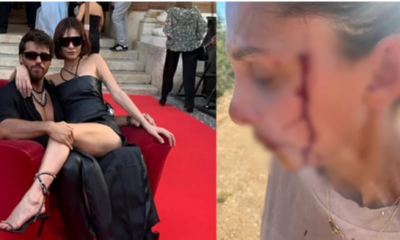 Can Yaman’ın sevgilisi kanlar içinde paylaşım yaptı!